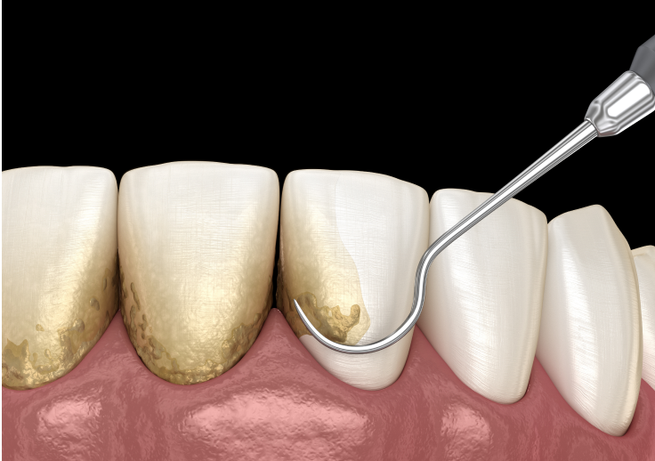 この4つの要素が重なることで発生します