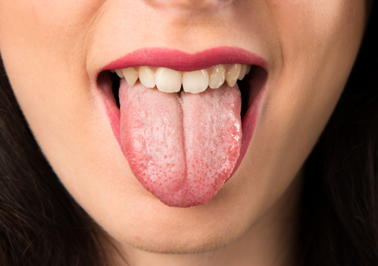 舌苔（ぜったい）