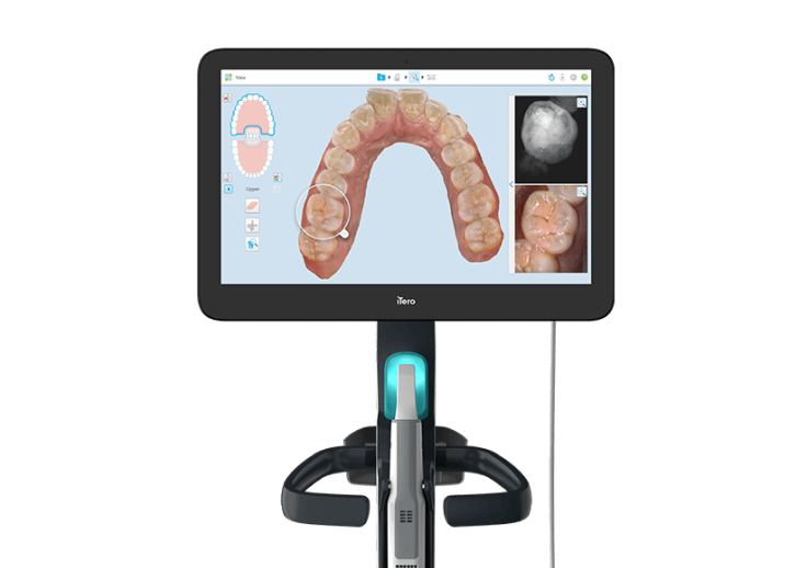精密検査・口腔内スキャン