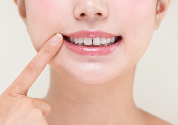 「インビザライン・ライト」による部分矯正