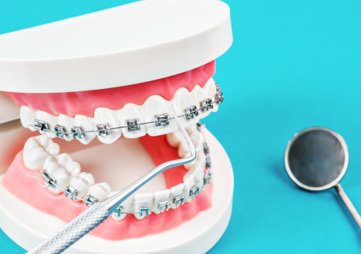 ブラケット矯正（目安：10歳頃〜）