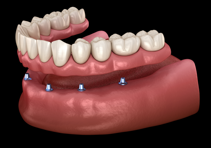 インプラントオーバーデンチャー