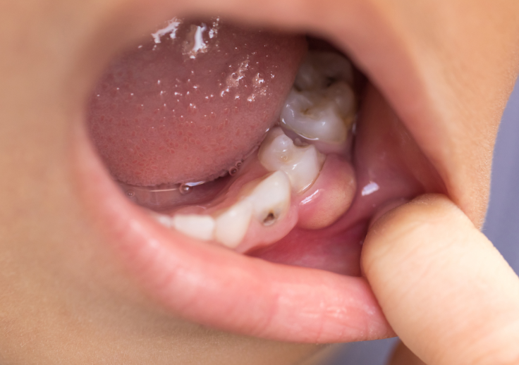 歯が黒いのは虫歯それとも汚れ？歯が黒くなる原因と対処法・予防法