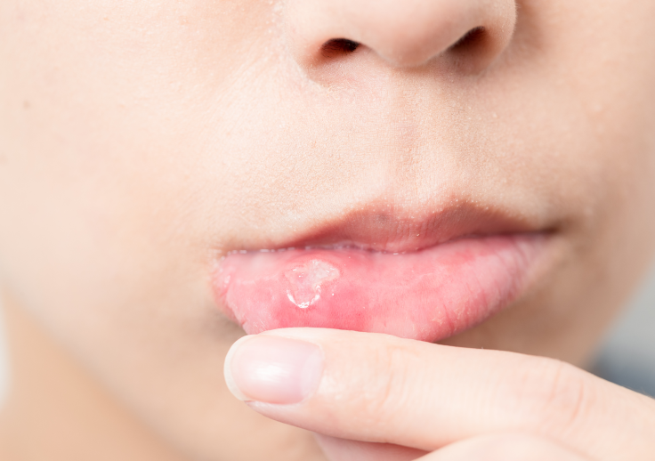 痛～い口内炎、何とかしたい