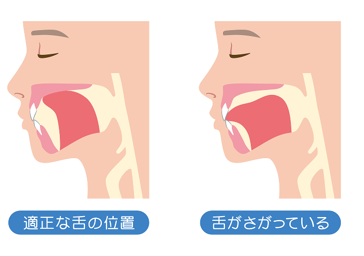 口呼吸・ポカン口の改善