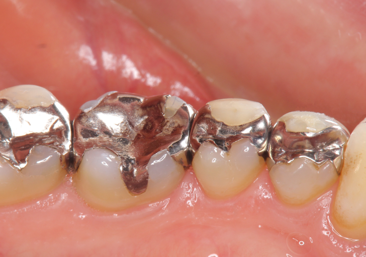 一生物ではなかった銀歯の寿命