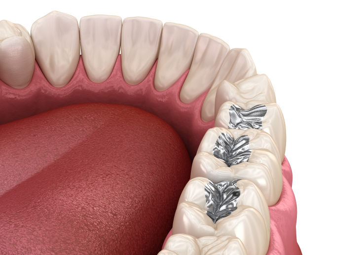 銀歯は虫歯再発リスクが高い？銀歯のデメリットと銀歯を使わない治療